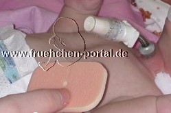 Stomapflege beim frühgeborenen Kind