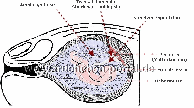Chorionzottenbiopsie