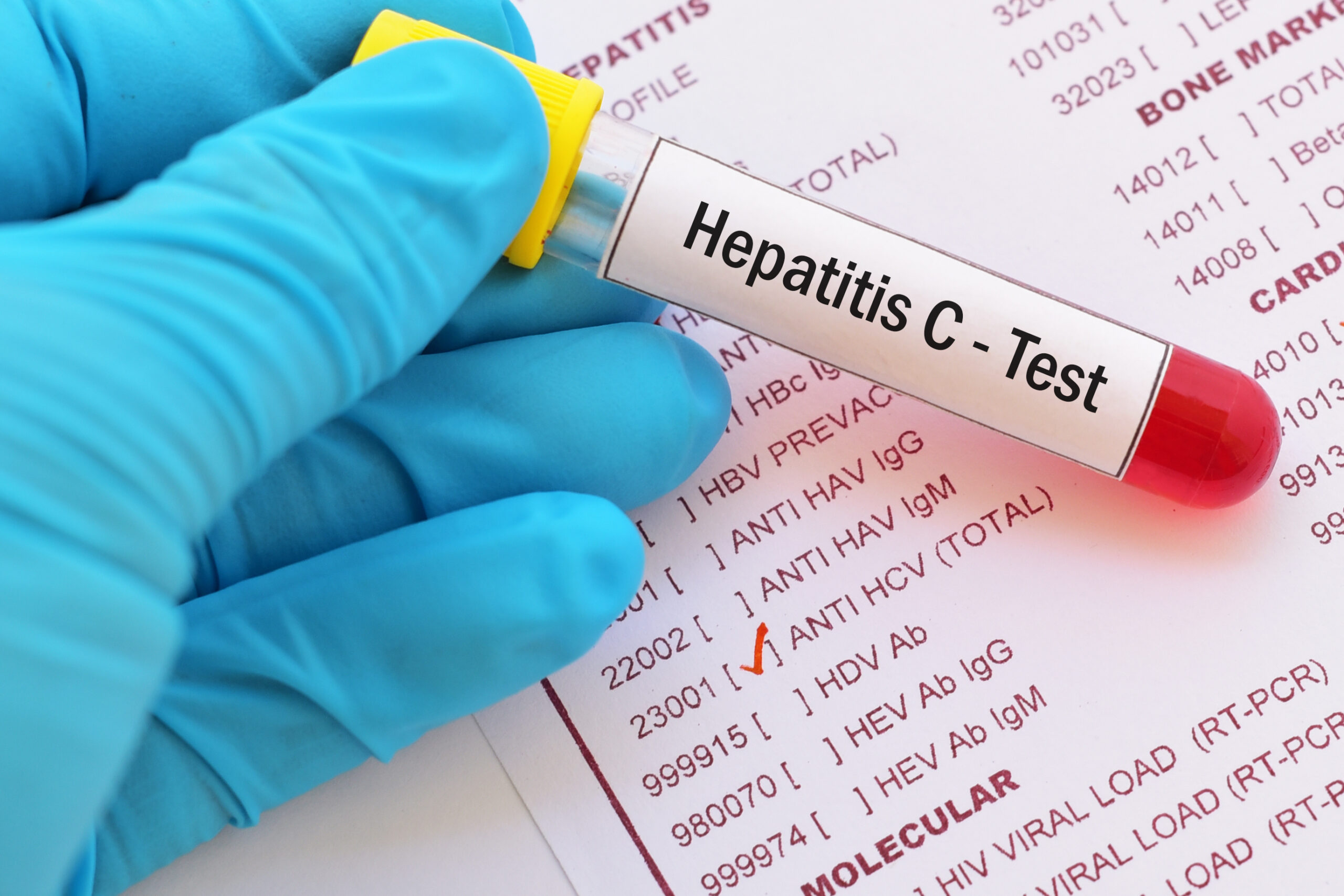 Teströhrchen für Hepatitis Test
